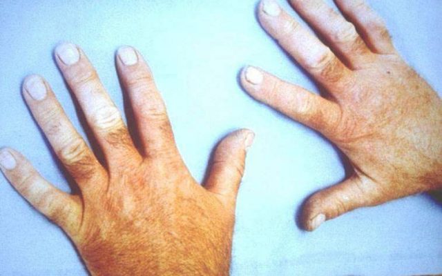 Vibration white finger