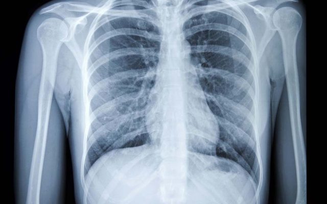 chest xray